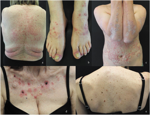 Figure A1. Cutaneous immune-related adverse events usually reported as “skin rash”: A maculopapular rash; B lichenoid reaction; C psoriatic rash; D neutrophilic rash; E Grover’s disease.