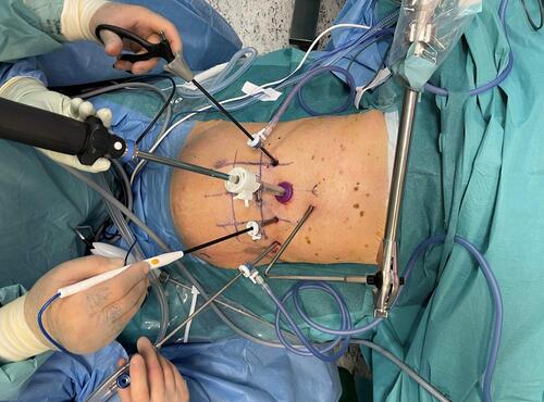 Figure 3 Trocar position on the abdominal wall for transperitoneal laparoscopic decompression of the celiac artery in a patient with median arcuate ligament syndrome.