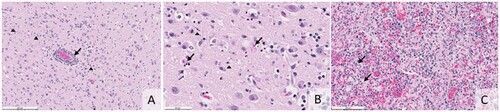 Figure 1. (A) Histologic section shows monocular perivascular cuffing with rarer neutrophils (arrow). Cellular debris and reactive glia are present throughout the grey matter (arrowheads, H&E, bar = 200 microns). (B) Histology of the cerebral cortex illustrating neuronal necrosis (arrows) and small deposits of nuclear debris in the grey matter (arrowheads, H&E, bar = 50 microns). (C) Histology of the lung shows macrophages, neutrophils, and fibrin flooding and obliterating the alveoli. In areas, there is type 2 pneumocyte hyperplasia (arrows, H&E, bar = 100 microns).