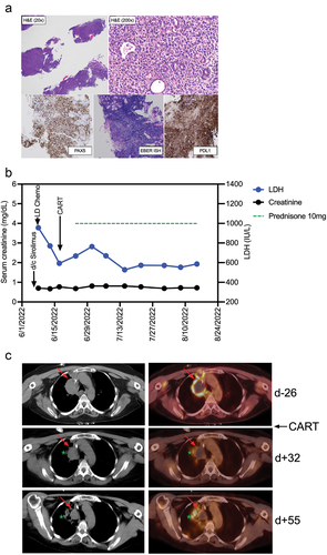 Figure 2. Diagnosis and clinical course of PTLD in a kidney transplant recipient treated with CD19 CAR-T cells histologic images from the gastric antral soft tissue nodule biopsy, examination at low power magnification demonstrates thin cores of tissue with a focal area of intact gastric mucosa (right side of figure), and architectural effacement of the remaining tissue by a hypercellular diffuse lymphoid infiltrate (H&E stain, 20× magnification). Examination at higher magnification reveals an infiltrate of large atypical lymphoid cells forming sheets and infiltrating residual mucosal epithelium, with moderate cytologic atypia and pleomorphism (H&E stain, 200× magnification). Immunohistochemical and in situ hybridization (ISH) stains demonstrate strong diffuse positivity of the CD20-expressing lymphocytes for PAX5 (40× magnification), EBER ISH (40× magnification), and PDL1 with negativity for CD10 and Ki-67-positivity in 90% of cells (data not shown). (b) Clinical course after discontinuation of sirolimus, lymphodepleting (LD) chemotherapy with fludarabine/cyclophosphamide, and CAR-T cell infusion. Post-CAR-T corticosteroid dosing is shown as a green dotted line, serum concentrations of lactate dehydrogenase (LDH) and creatinine are shown in blue and black, respectively. (c) PET-CT Images from before CAR-T cell treatment (d-26), and two timepoints (d + 32 and d + 55) after CAR-T cell treatment. The upper panel (pre-CAR-T; d-26) shows an index right upper mediastinal mass (left: CT, right: fused PET/CT) measuring 5.0 × 3.6 cm with central photopia and peripheral increased F-fluorodeoxyglucose (FDG) uptake on PET representing active lymphoma (indicated by red arrow). The middle panel (d + 32) shows a decreased size (3.4 × 3.0 cm) of the index lesion with mild residual peripheral FDG uptake representing partial metabolic response to the treatment. The green star indicates a new infectious pulmonary process in the right upper lobe. The lower panel (d + 55) shows a further decrease in size (3.0 × 2.6 cm) of the mediastinal index lesion with resolution of the peripheral FDG uptake, representing a complete metabolic response.