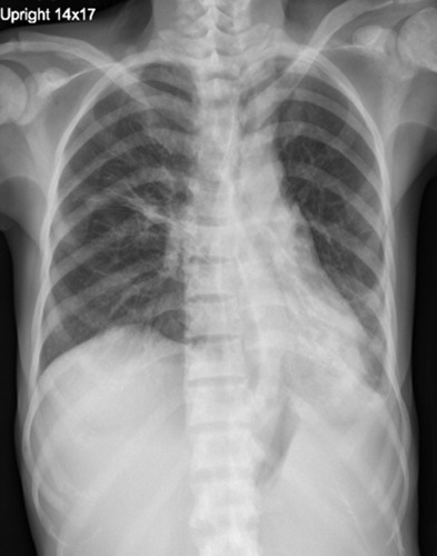 Figure 3 The follow-up chest radiography obtained after six months of antifungal therapy showing a marked decrease in the size of alveolar opacity at the right upper lung and left lower lung, including left pleural effusion.