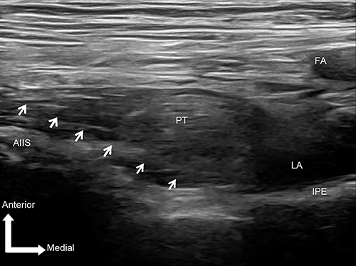Figure 1 Images of ultrasound-guided pericapsular nerve group (PENG) block. The needle tip was positioned between the psoas tendon and the pubic ramus using an in-plane approach. The needle is outlined by the arrows; arrow, needle pathway.
