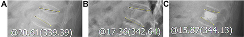 Figure 3 The patient was a 65-year-old woman with a T12 osteoporotic vertebral compression fracture and percutaneous vertebroplasty was performed. The yellow line indicates the kyphotic angle. The kyphotic angle changed from 20.61° in preoperative standing lateral radiographs (A) to 17.36° in intraoperative prone lateral radiographs (B). So the dynamic fracture mobility was present. After operation, the kyphotic angle changed to 15.87° in postoperative standing lateral radiographs (C). The kyphotic angle correction due to percutaneous vertebroplasty itself was 1.49°.