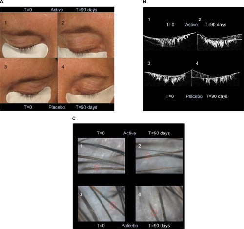 Figure 2 Effect of eyelash gel on (A, B) eyelash length and (C) thickness.