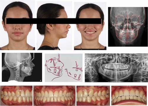 Figure 5. Final records after 26 months of active orthodontic treatment after the condylectomy