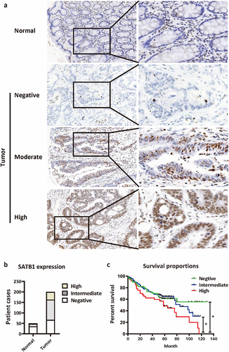 Figure 1. Expression of SATB1 in the CRC tissues and its association with prognosis. (a) SATB1 staining in normal mucosal glandular epithelium and CRC tissues. In normal intestinal mucosa, SATB1 showed no staining in epithelial cells, whereas it showed strong positive staining in interstitial lymphocytes. In the tumor epithelial cells, SATB1 showed variable staining, including negative, moderate and strong staining. (b) The number of cases with different degree of SATB1 expression. (c) Kaplan-Meier survival curve of CRC patients with different degree of SATB1 expression. *p < .05 (log-rank test).
