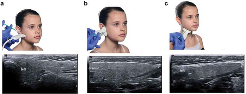 Figure 3. Insertion sites for the ultrasound probe and needle for injection of incobotulinumtoxinA into the parotid gland (a) vertical and (b) horizontal, and (c) the submandibular gland. Resulting ultrasound images are also shown for each injection site