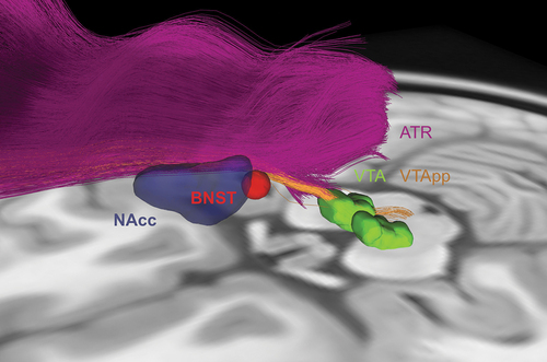 Figure 4. Tractography for ventral capsule/ventral striatum (VC/VS) and bed nucleus of the stria terminalis (BNST) DBS. VC/VS and BNST DBS are currently performed using stereotactic coordinates to target the NAcc (blue) and BNST (red) respectively, with the lead passing through the internal capsule. These targets are in close proximity to each other and to white matter tracts associated with depression-related networks, such as the ventral tegmental area projection pathway (VTApp) (orange) and anterior thalamic radiation (ATR) (purple). As such, there is potential for tractography to guide lead placement in this region.