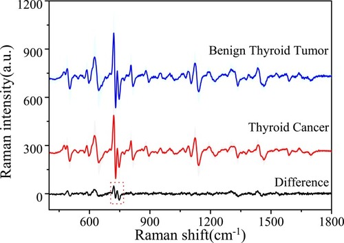Figure 6 Plot of first derivative SERS and difference spectrum for benign thyroid tumor (32, blue curve with the green-shaded area) and thyroid cancer (70, red curve with the gray-shaded area), the black curve indicates the corresponding difference spectrum.