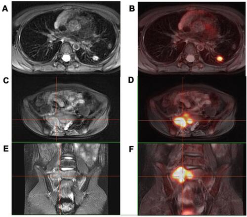 Figure 2 Multiple system LCH in children (female, 8 years old) with nodular lesions in the left lower lobe of the lung, increased FDG metabolism (A and B), and right sacral soft tissue density mass bone destruction, FDG metabolism increased (C–F). (left columns: T2-weighted images; right columns: PET/MR images).