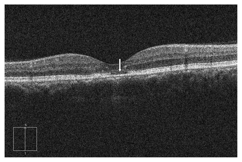 Figure 2 The optical coherence tomography of a patient with photoreceptor disruption demonstrated total absence of inner segment/outer segment line (arrow).