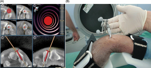 Figure 4. (A) Navigation screen for the 3D-navigated screw insertion. The presentation of multiplanar reconstructions allows exact positioning of the screw with respect to the drill. The head of the red screw corresponds to the end of the instrument to be navigated. The solid line indicates the extended virtual direction of the drill guide. (B) The navigated drill guide with the K-wire already inserted.