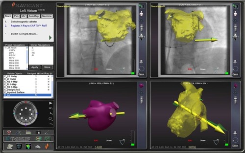 Figure 4 Navigant system screen that enables real-time navigation through different parts of the heart by simply orienting vectors from the keyboard where the doctor is positioned to work remotely from the patient.