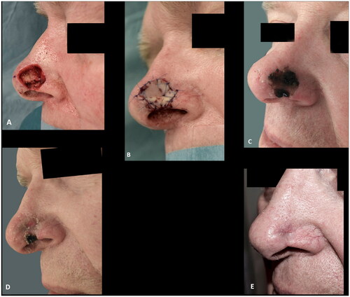 Figure 2. (A,B) A defect after radical resection of basal cell carcinoma involving the alar rim reconstructed with a composite graft. (C) Epidermolysis eleven days after surgery. (D) The graft at two months follow up. (E) Despite the partial graft loss and alar retraction at three months follow up the outcome was rated as acceptable.