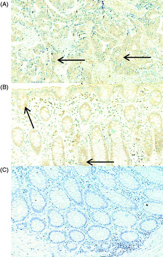 Figure 4. Representative immunohistochemical staining of PLA2G4C in cancer and normal tissue from patients with CRC. The PLA2G4C protein expression is present in cancer (A) and in normal (B) epithelial cells. The arrows indicate positive brown staining. Control staining of normal tissue (C) with only the secondary antibody. Magnification, ×20.