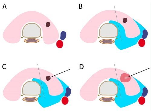 Figure 1. Schematic diagram of microwave ablation for papillary thyroid microcarcinomas. A. Anatomical structure of the neck; B. Normal saline is injected as a spacer fluid to separate the normal tissues from the ablation area; C. The needle or antenna is inserted into the tumor lesion; D. An extended ablation area is introduced.