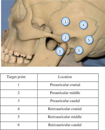 Figure 2. The locations of the six precisely defined bone-implanted target fiducials demonstrated on an anatomical model.