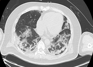 Figure 1 Chest CT screenshot upon admission.