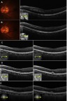 Figure 1 Fundus photographs and B-scan OCT images of the left eye in case 1. Images were obtained at the first examination (4 days after the onset) (A), and then at 1 month (B), 6 months (C), 4 years (D), and 5 years (E). (A) Fundus photograph shows a small dark gray lesion supero-nasal to the fovea. OCT shows a hyperreflective band ranging from the inner plexiform layer to the OPL, which corresponded to the fundus lesion. (B) Fundus photograph shows there was a gradual disappearance of the lesion. OCT showed that the hyperreflective band was limited to the thinned inner nuclear layer. (C) OCT revealed there was a thin and irregular inner nuclear layer and OPL with the hyperreflective change no longer present. (D and E) Additional OCT images show the presence of focal serous retinal detachment, with an excavated change of the inner retinal surface and thickening of the outer nuclear layer.