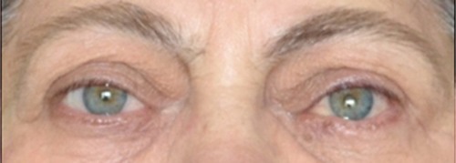 Figure 5 The patient’s appearance 16 months after bony orbital decompression and strabismus surgery. Orthotropy in primary gaze position.