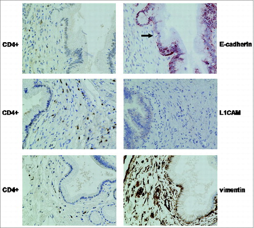 Figure 9. Distribution of CD4+ T cells and EMT markers in PanINs within CP tissues. Representative E-cadherin, L1CAM and vimentin stainings of CP tissues demonstrate partially reduced E-cadherin expression (indicated by the arrow) and enhanced L1CAM and vimentin expression in PanINs surrounded by a dense stroma enriched with CD4+ T cells (magnification x 400). Note, that besides vimentin expression in PanINs surrounded by a CD4+ T cells containing stroma, the stromal compartment itself was characterized by strong vimentin expression, too.