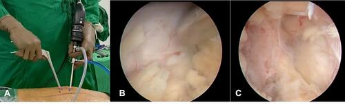 Figure 2 (A) Working position using unilateral biportal endoscopy. (B) Flavectomy piece by piece using Kerrison punch. (C) Contralateral decompression.