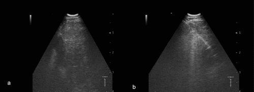 Figure 3. Suspect lesion in the pancreas visualized by EUS-B (a, arrow). EUS-B-FNA from the suspected lesion in pancreas (b, dotted arrow).