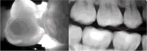 Figure 2. Caries lesion involving the enamel on tooth 15 visualized using near-infrared transillumination and X-rays.