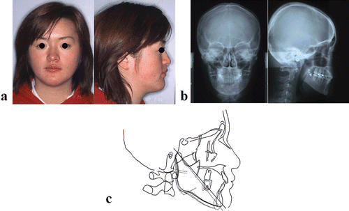 Figure 17. Soft tissue and skeletal findings after 8 months of post-surgical orthodontic treatment. (a) Soft tissue findings. (b) Cephalometric findings. (c) Superimposition of the lateral cephalometric tracings (solid line = 8 months after surgery; dotted line = 1 day after surgery). [Color version available online.]