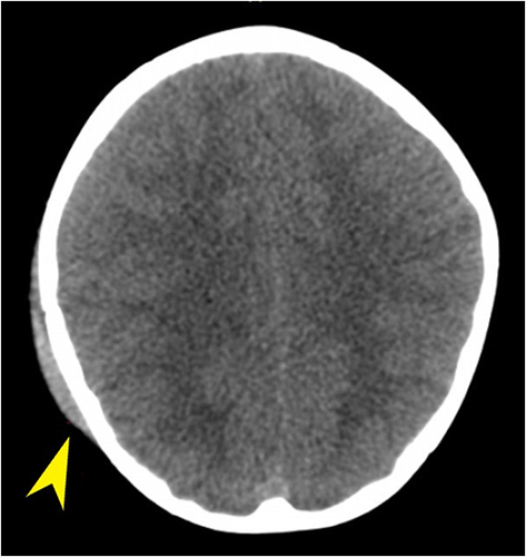 Figure 1 Axial NECT of a 2 years 7 months old girl who fell on the stairs. Brain window shows right temporo-parietal epicranial haematoma (Yellow arrow).