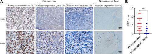 Figure 1 Immunohistochemical expression of FEN1 in osteosarcoma and non-neoplastic bone specimens. (A) The different intensities of positive expression in specimens. Scale bars, 100 μm (upper) and 25 μm (down). (B) The difference of immunohistochemical scores between osteosarcoma group and non-neoplastic bone group. ***P<0.001.