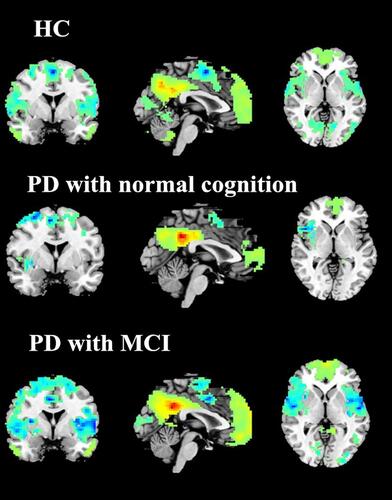 Figure 1 Whole-brain voxelwise pattern of the default mode network in each group. The DMN pattern for each group was obtained by using PCC (MNI coordinate: −2, −45, 34, radius = 6 mm) seed-based functional activity analysis. The random-effects one-sample t-test was performed and threshold was set at a corrected P < 0.01, determined by Monte Carlo simulation.