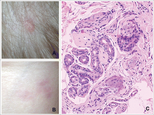 Figure 1. Images of a patient with FOP. (A) Ossification nodule at the scalp level; (B) photograph of the back, with multiple erythematous papules; (C) biopsy of the skin on the back: aspects of ossification in the dermis around sweat glands. Reprinted with permission from reference 52.