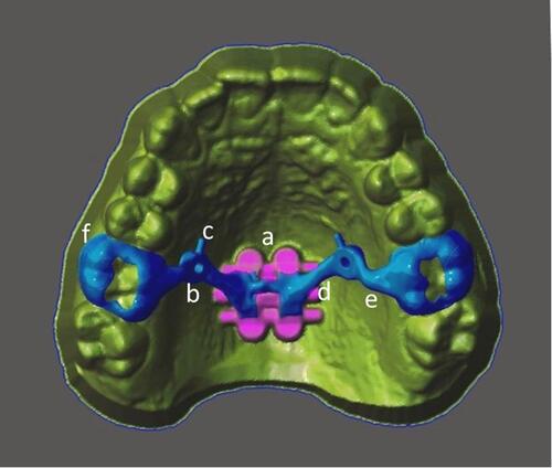 Figure 6 Virtual model of cad-cam structure. (a) MSE body. (b) Bushing for lateral miniscrew. (c) Pin for steel ligature tie. (d) Connecting arm between bushing and MSE body. (e) Connecting arm between bushing and molar band. (f) Cad-cam molar band.