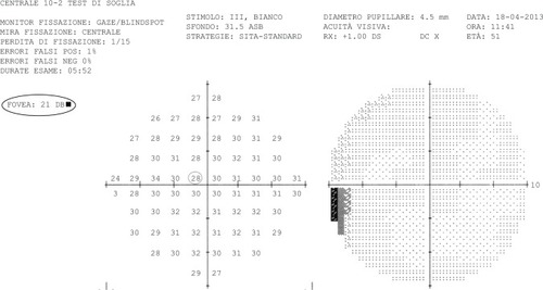 Figure 3 Central 10 degree perimetry from April 2013 showing disappearance of the previous scotoma and sensitivity improvement to 28 dB at the same point (shown by gray circle in the left numerical pattern). Foveal threshold increased to 21 dB (shown by oval gray line).