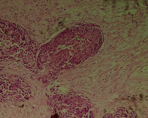 Figure 3 Nests of infiltrating carcinoma show squamoid differentiation. H&E, 100X.