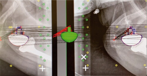 Figure 3. Radiostereometric analyses were performed with RSAcore software using reversed engineering (RE). The virtual glenoid implant (green) corresponds with the red demarcated outline of the actual glenoid implant shown on dual simultaneous radiographs of a right-sided shoulder with a reverse total shoulder arthroplasty. RSA markers are red, control markers are green, and fiducial markers are yellow.