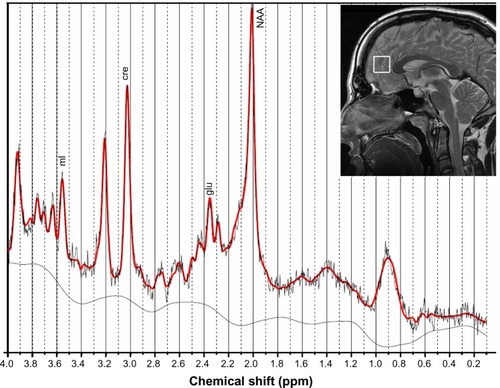Figure 2 The voxel of interest was placed in the midline in the pregenual anterior cingulate cortex with the inferior border along the anterior-posterior commissure line. An example of the metabolite spectrum is shown, along with peaks for the analyzed metabolites.