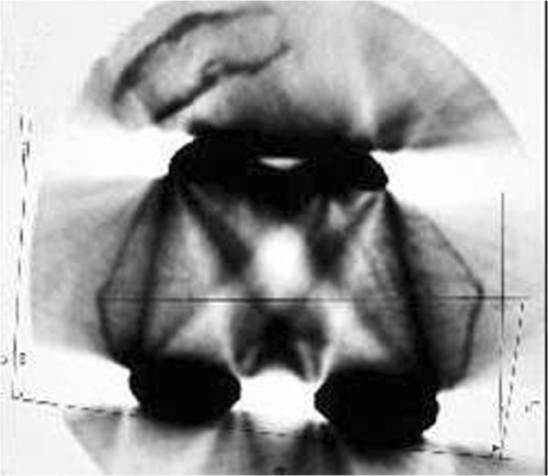 Figure 1. A preoperative CT scan of the lower femur was required to determine the posterior condylar angle with the original femoral component in place. In this example, the femoral component was implanted in internal rotation with a subluxated patella.