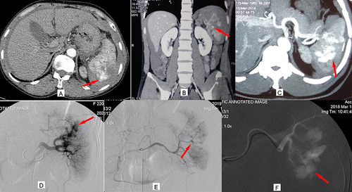 Figure 1 Three types of intraparenchymal splenic vascular injury on MDCT and angiography: Active bleeding ((A) and (D), arrows); Pseudoaneurysm ((B) and (E), arrows); Arteriovenous fistula ((C) and (F), arrows).