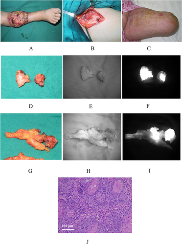 Figure 6 Intraoperative ICG fluorescence imaging of the well differentiated squamous cell carcinoma of the right leg. (A) The gross appearance of the tumor; (B) The gross appearance of the operation area in the right groin; (C) The postoperative residual limb; (D) The gross appearance of two lymph nodes in the right groin; (E) Visible light image of the two groin lymph nodes; (F) Fluorescence image of the two groin lymph nodes; (G) The gross appearance of another two lymph nodes in the right groin; (H) Visible light image of another two groin lymph nodes; (I) Fluorescence image of another two groin lymph nodes; (J) The HE staining of the resected tumor tissues. The scale bar indicates 100 μm.