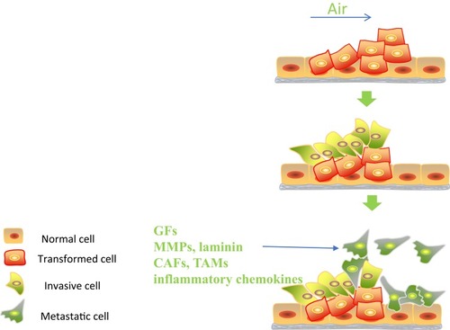 Figure 1 The potential mechanism of STAS.Abbreviations: GFs, growth factors; MMPs, matrix metalloproteinases; CAFs, cancer-associated fibroblasts; TAMs, tumor-associated macrophages.