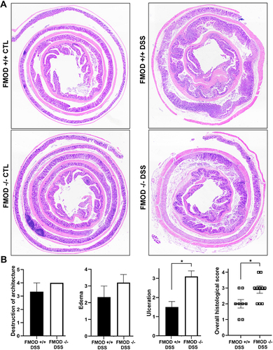 Figure 3 FMOD depletion facilitates DSS-induced pathological changes in the colon. (A) FMOD+/+ (n=8) and FMOD-/- (n=10) mice were given 3% DSS in drinking water for 7 days. Paraffin-embedded sections of the colon Swiss rolls were H&E stained. Images were obtained with x4 magnification. (B) Histological scores for the destruction of architecture (0–4), edema (0–4), ulceration (0–4), and overall score (0–3) of the full-length colon given in a blinded fashion are plotted. Data are represented as the mean ± SEM of 3 control and 8 treated FMOD+/+, and 4 control and 10 treated FMOD-/- animals. *P < 0.05 by unpaired, two-tailed t test with Welch’s correction.
