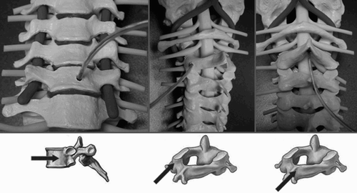 Figure 5. Due to the differing anatomy of the individual vertebral bodies of the cervical spine, different locations were sought for the intermittent implantation of microsensors.