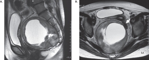 Figure 3. Sagittal image (A) and axial image (B) of T2-weighted MRI showing a giant tumor with a cystic component at the presacral retroperitoneal space displacing intrapelvic organs including the bladder and rectum (white arrow). To excise the tumor, the resection and re-anastomosis of the sigmoid colon was performed by the anterior approach.