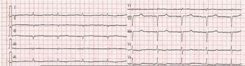 Figure 1 Electrocardiogram revealed sinus rhythm, low voltages in limb leads, QS waves indicative of pseudoinfarction in precordial and inferior leads, first-degree atrioventricular block, and prolonged QTc.