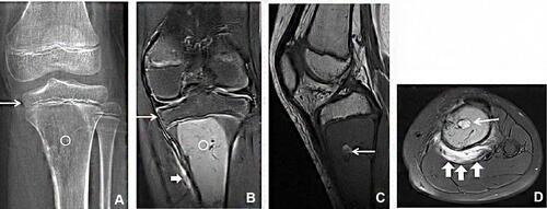 Figure 3 A skeletally immature 9-year-old girl with GCTB in the proximal tibia. Plain radiograph (A) demonstrates an osteolytic lesion (white circle) centered in the metadiaphysis, sparing the epiphysis (arrow in a). Coronal fat-suppressed T2 (B), sagittal T1 (C), and axial fat-suppressed T2 (D) show a solid lesion (white circle) in the proximal tibial metadiaphysis with sparing of the epiphysis (arrow in b). The lesions were mainly solid, with a few cystic components (arrows in c and d). Adjacent soft tissue edema were shown on coronal and axial T2WI (thick arrows in b and d).