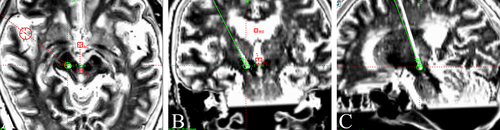 Figure 2 (A–C) The fusion results of preoperative MR and postoperative CT show that the position of the deep brain stimulation electrode was accurate, and the electrode passed through both the VIM and PSA simultaneously.