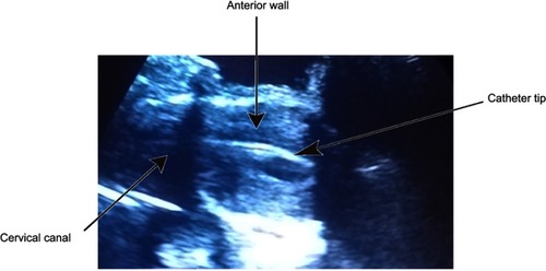 Figure 4 Catheter tip resting against anterior wall intra lavage.