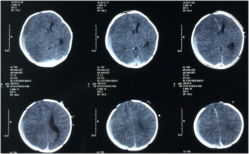 Figure 1. Preoperative head CT scan.